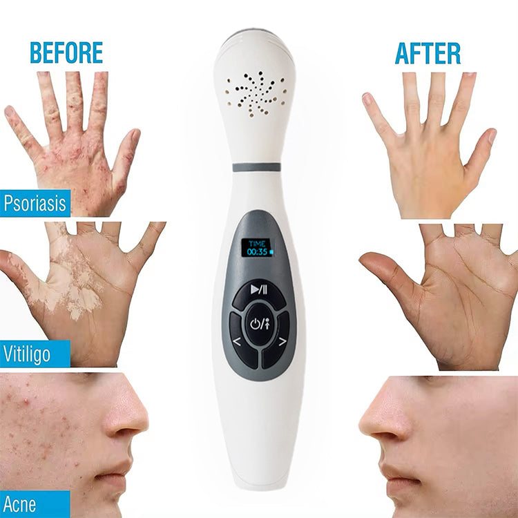 308 Excimer for Skin Disease Vitiligo 308nm Industrial Excimer Laser